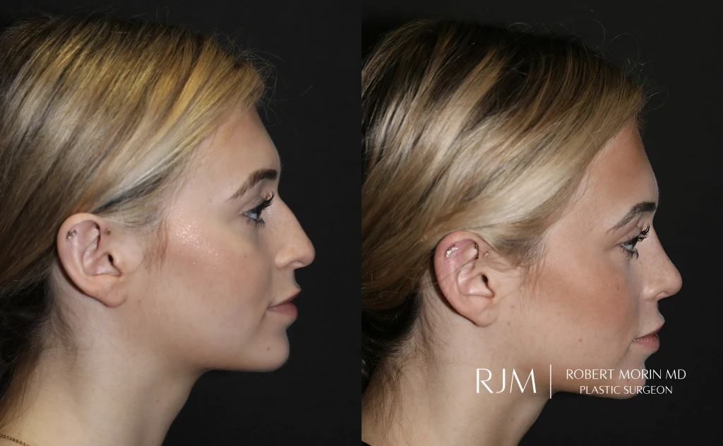  rhinoplasty patient 7 right side ba