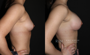  Breast augmentation before and after Robert Morin MD