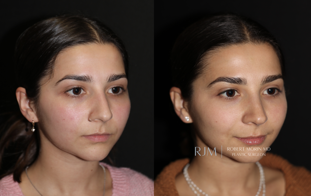  Rhinoplasty before and after Robert Morin MD