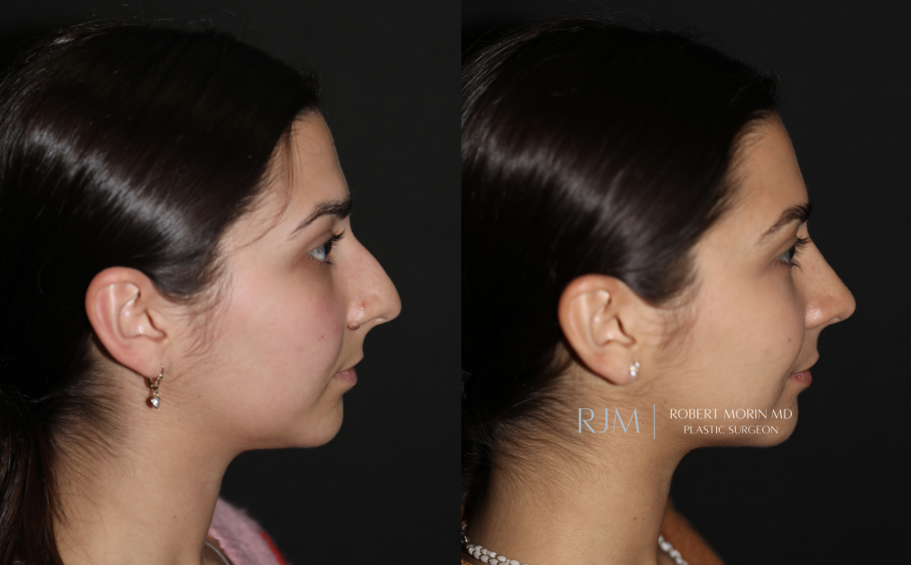  Rhinoplasty before and after Robert Morin MD
