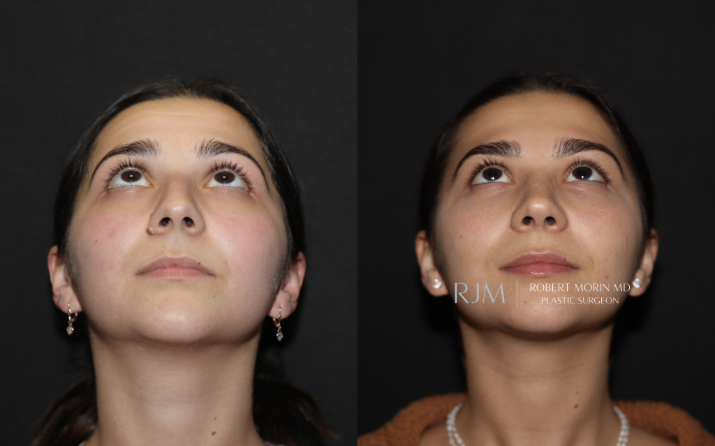  Rhinoplasty before and after Robert Morin MD