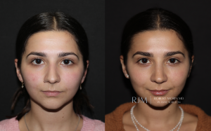  Rhinoplasty before and after Robert Morin MD