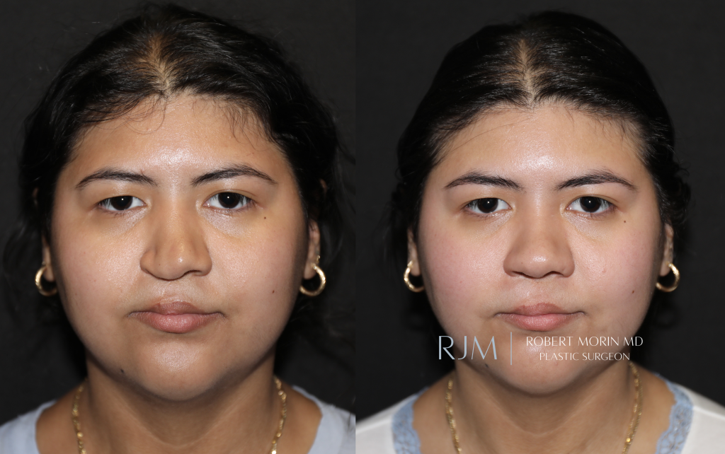  Before and after photograph cleft lip rhinoplasty Robert Morin MD