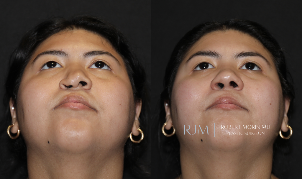  Before and after photograph cleft lip rhinoplasty Robert Morin MD
