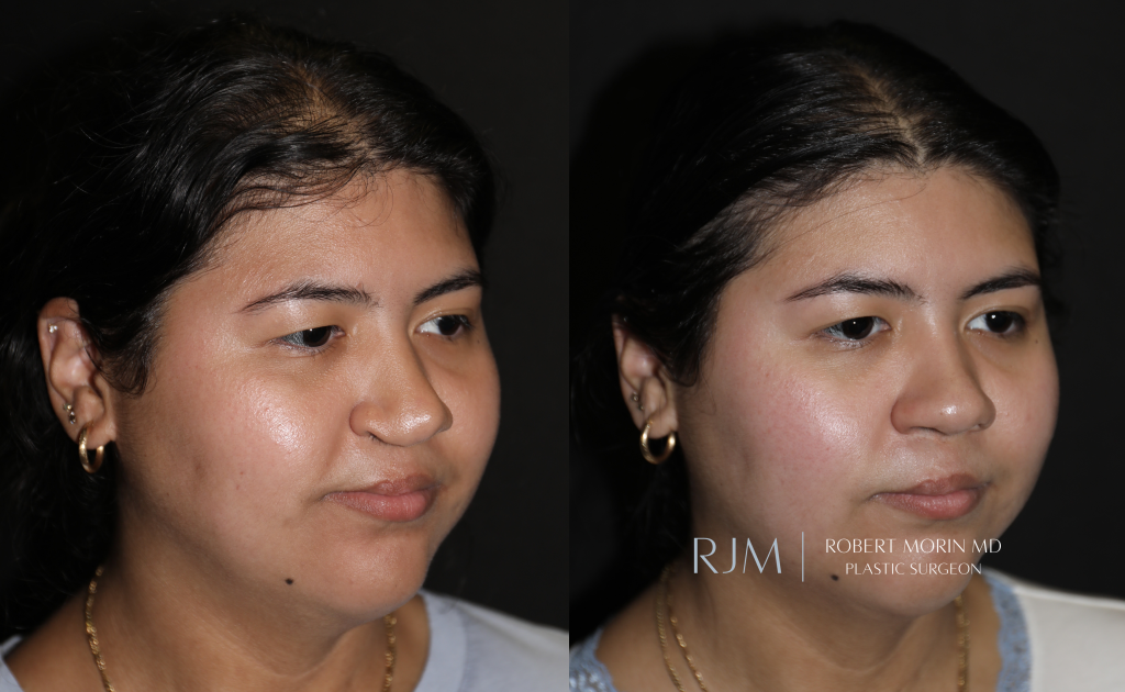 Before and after photograph cleft lip rhinoplasty Robert Morin MD