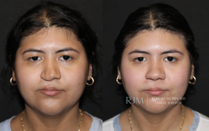  Before and after photograph cleft lip rhinoplasty Robert Morin MD