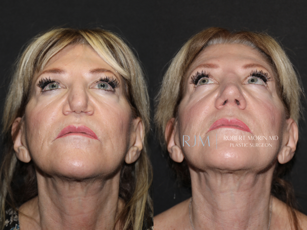  Revision rhinoplasty before and after photo Robert Morin MD New Jersey