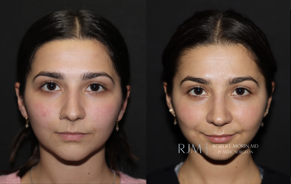  Beautiful cosmetic rhinoplasty before and after photo Robert Morin MD New Jersey