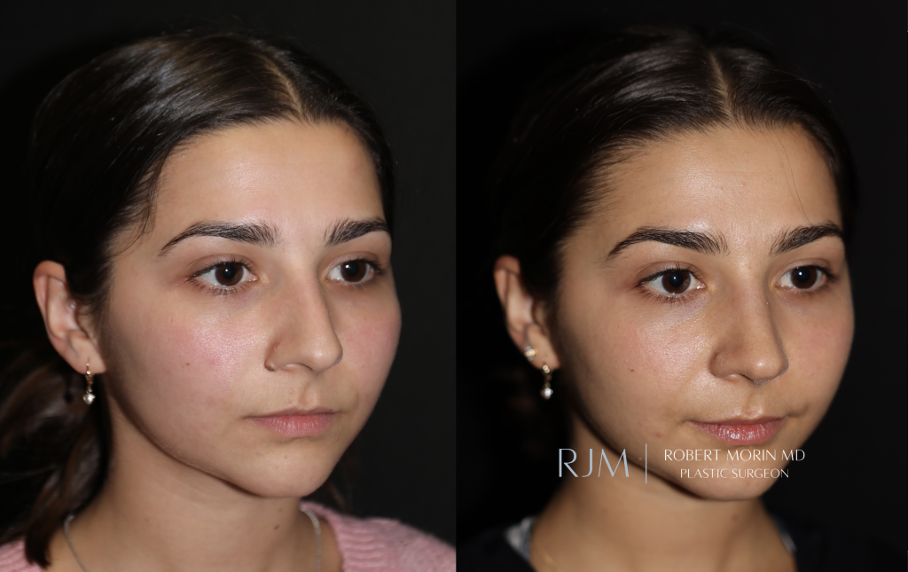  Beautiful cosmetic rhinoplasty before and after photo Robert Morin MD New Jersey