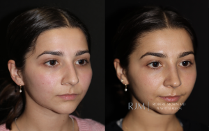  Beautiful cosmetic rhinoplasty before and after photo Robert Morin MD New Jersey