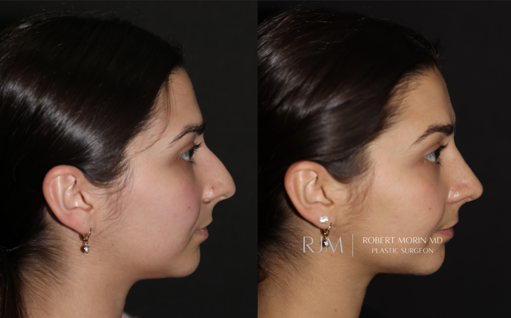  Beautiful cosmetic rhinoplasty before and after photo Robert Morin MD New Jersey
