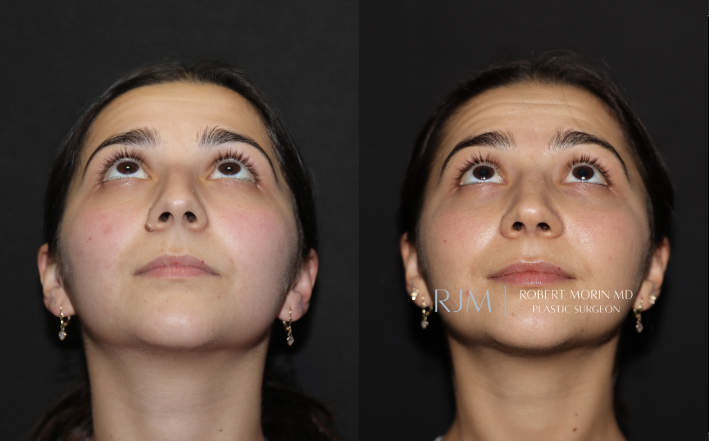  Beautiful cosmetic rhinoplasty before and after photo Robert Morin MD New Jersey