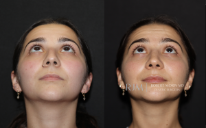  Beautiful cosmetic rhinoplasty before and after photo Robert Morin MD New Jersey