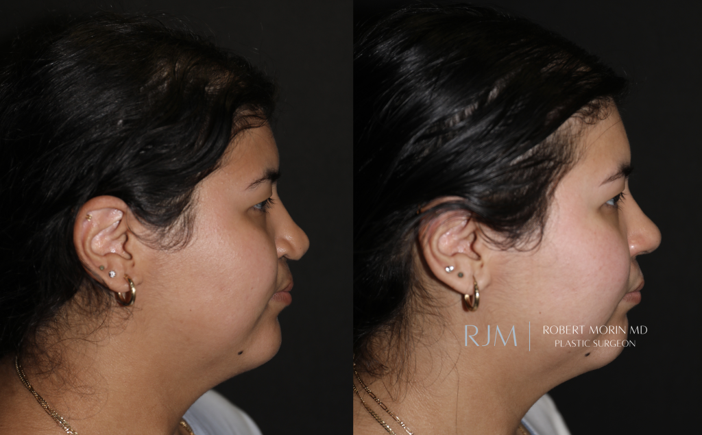  Before and after photograph cleft lip rhinoplasty Robert Morin MD