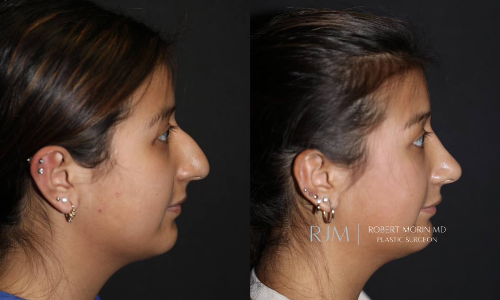  Cosmetic rhinoplasty surgeon before and after photo Robert Morin MD New Jersey