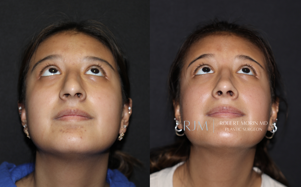  Cosmetic rhinoplasty surgeon before and after photo Robert Morin MD New Jersey