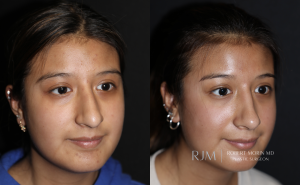 Cosmetic rhinoplasty surgeon before and after photo Robert Morin MD New Jersey