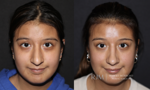  Cosmetic rhinoplasty surgeon before and after photo Robert Morin MD New Jersey