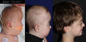  Cranial vault remodeling for bilateral coronal craniosynostosis Robert Morin MD