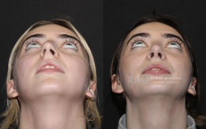  Rhinoplasty before and after photographs Robert Morin MD