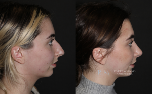  Rhinoplasty before and after photographs Robert Morin MD