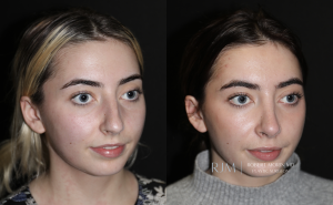  Rhinoplasty before and after photographs Robert Morin MD