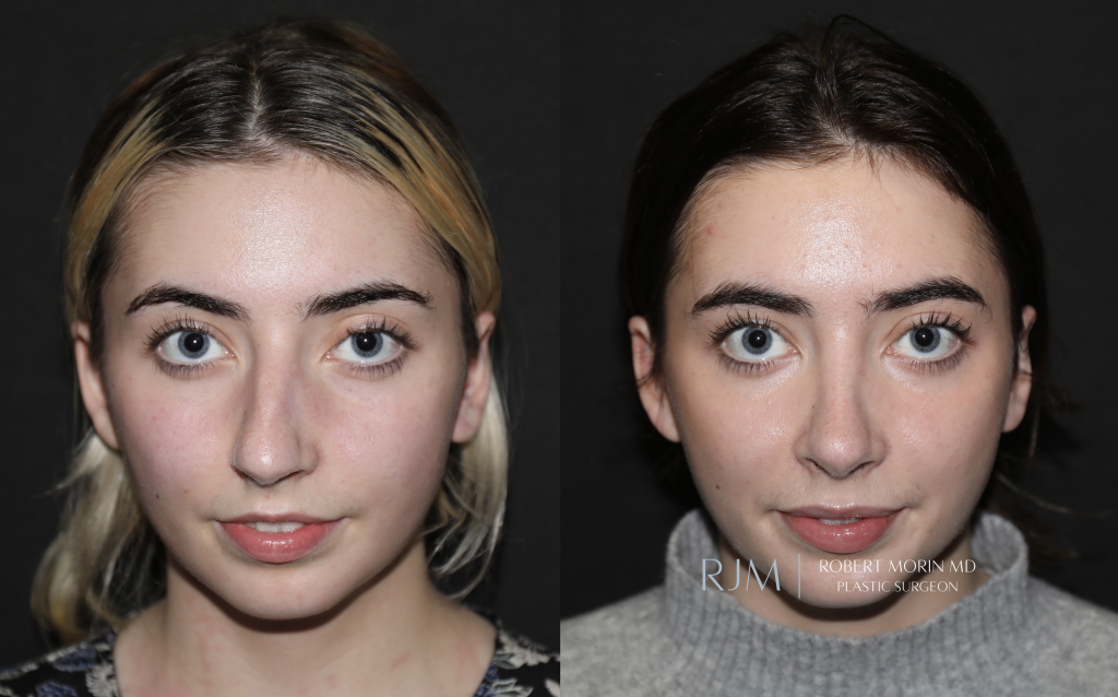  Rhinoplasty before and after photographs Robert Morin MD