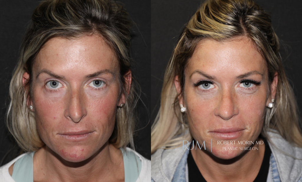  Revision rhinoplasty before and after photographs Robert Morin MD