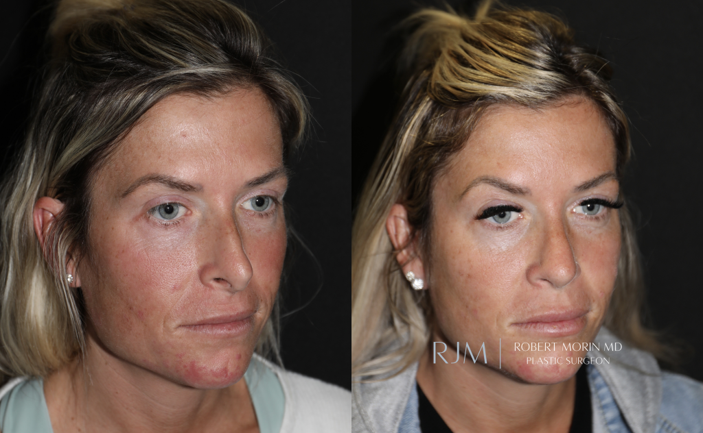 Revision rhinoplasty before and after photographs Robert Morin MD