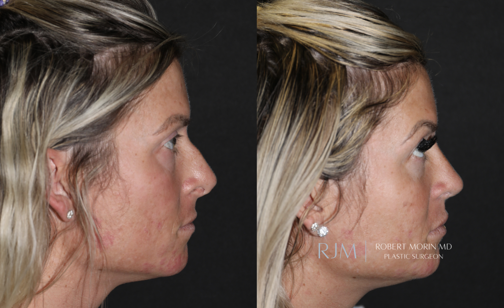  Revision rhinoplasty before and after photographs Robert Morin MD