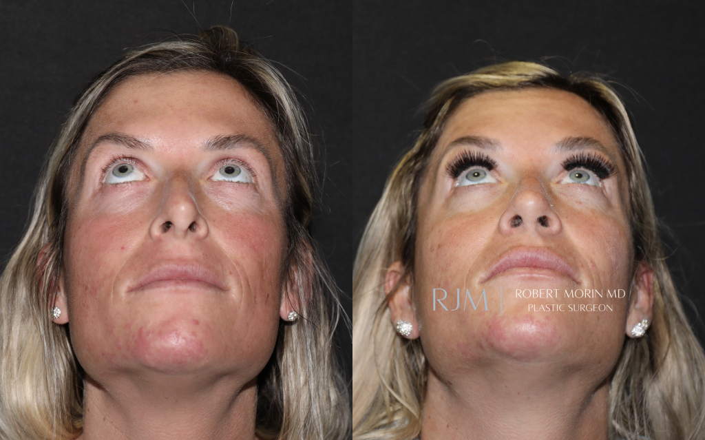  Revision rhinoplasty before and after photographs Robert Morin MD