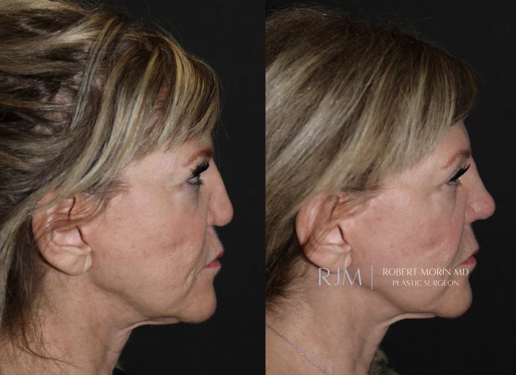  Revision rhinoplasty before and after photo Robert Morin MD New Jersey