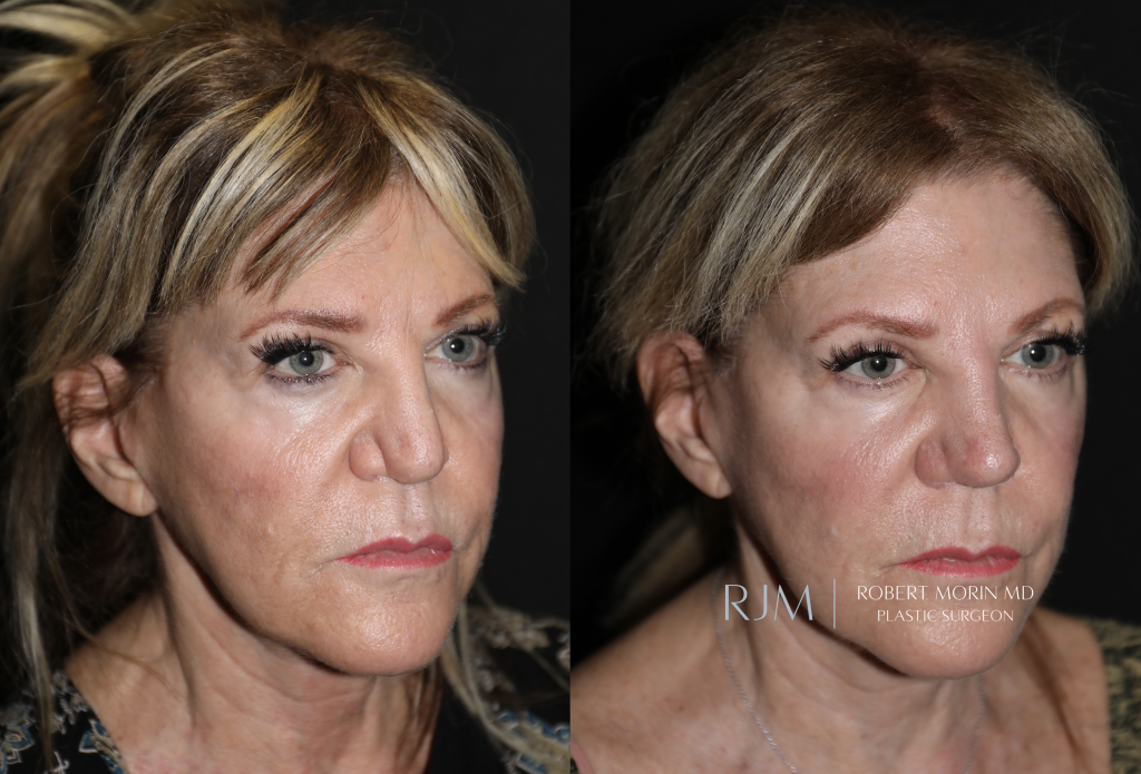  Revision rhinoplasty before and after photo Robert Morin MD New Jersey