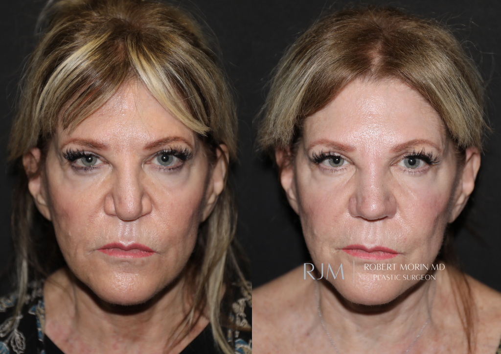  Revision rhinoplasty before and after photo Robert Morin MD New Jersey