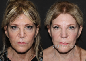  Revision rhinoplasty before and after photo Robert Morin MD New Jersey