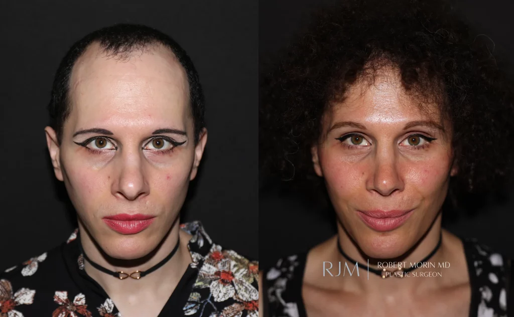  facial feminization patient 1 set 1