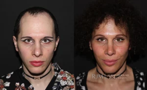  facial feminization patient 1 set 1