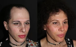  facial feminization patient 1 set 2