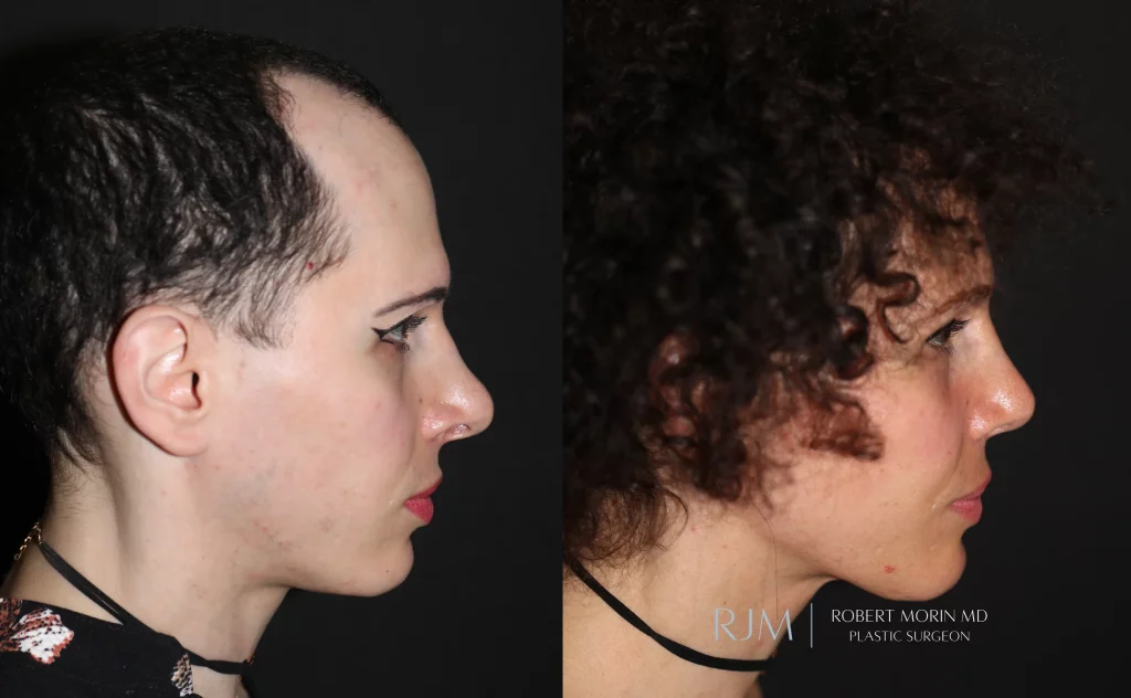  facial feminization patient 1 set 3