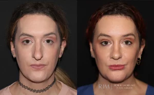  facial feminization patient 2 set 1