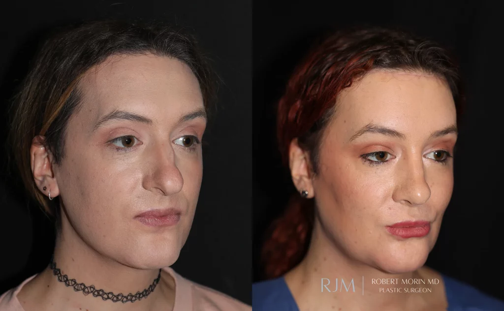  facial feminization patient 2 set 2