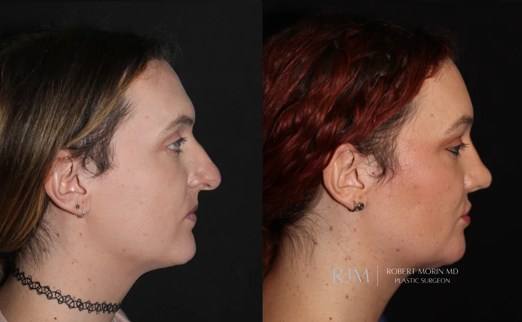  facial feminization patient 2 set 3