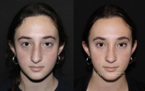  Rhinoplasty and septoplasty before and after photograph Robert Morin MD