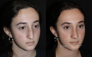  Rhinoplasty and septoplasty before and after photograph Robert Morin MD