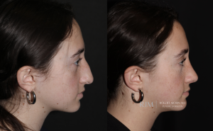  Rhinoplasty and septoplasty before and after photograph Robert Morin MD