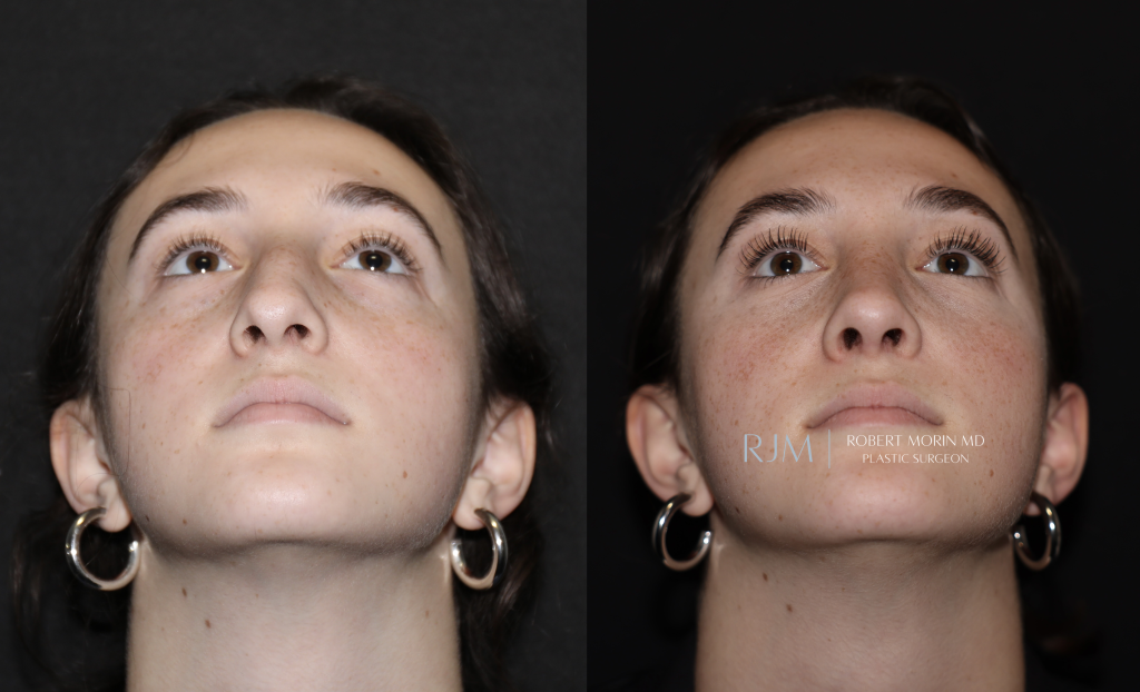  Rhinoplasty and septoplasty before and after photograph Robert Morin MD