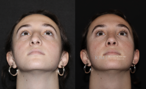  Rhinoplasty and septoplasty before and after photograph Robert Morin MD