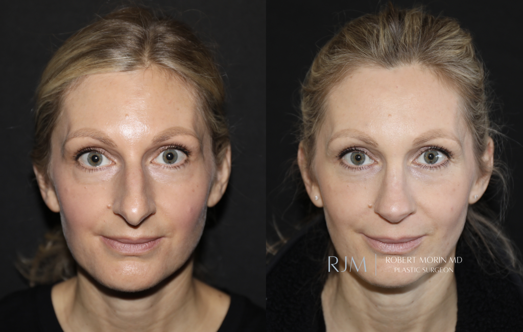  Cosmetic rhinoplasty before and after photograph Robert Morin MD