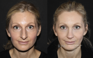  Cosmetic rhinoplasty before and after photograph Robert Morin MD