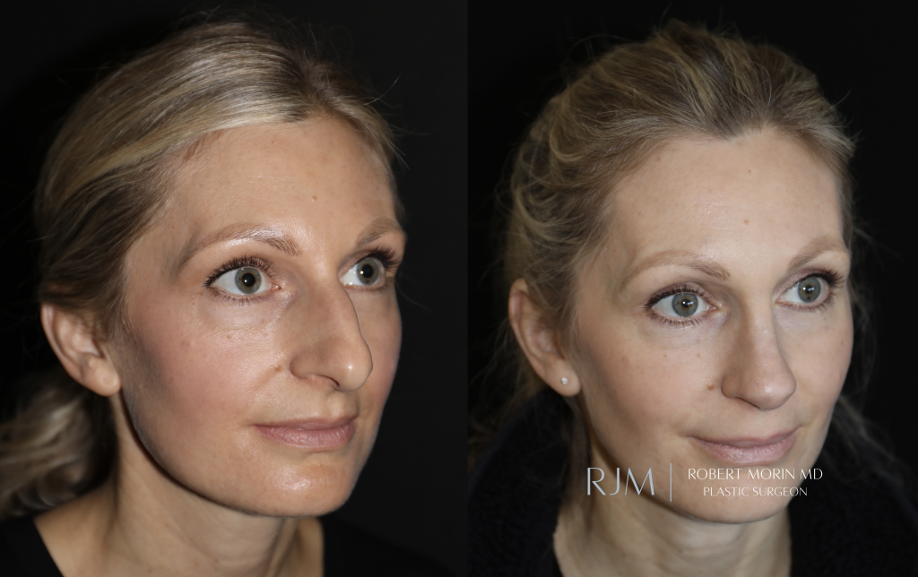  Cosmetic rhinoplasty before and after photograph Robert Morin MD